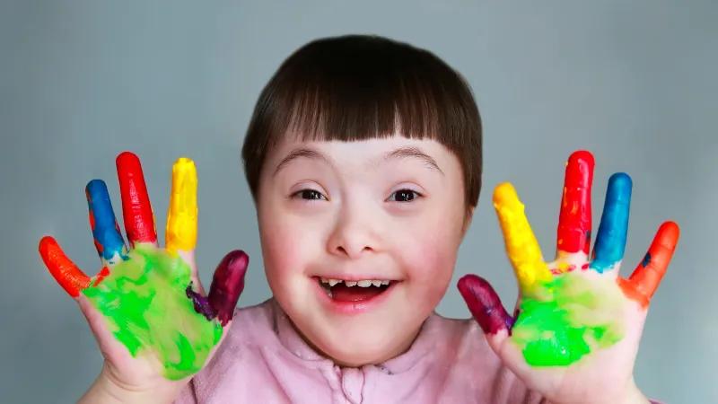 سندروم داون