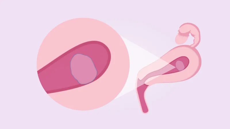 حاملگی پوچ چیست و چه علائمی دارد؟چه کسانی دچار آن می‌شوند؟