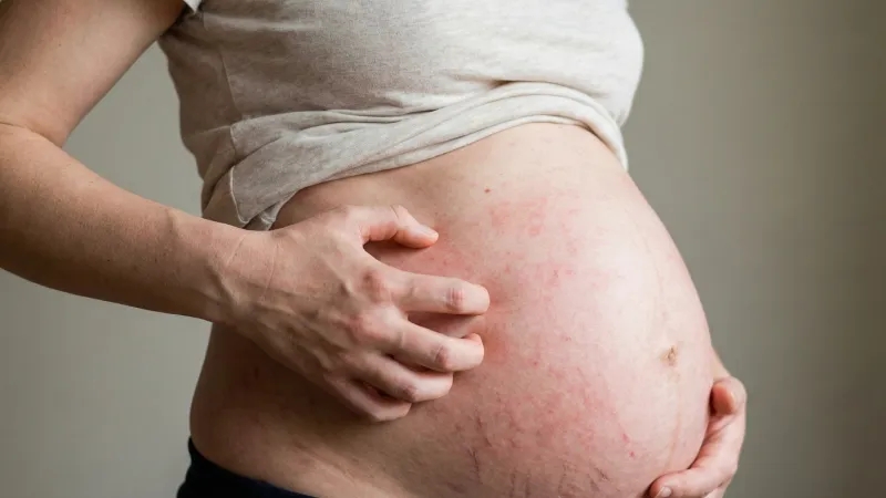 علت خارش بدن در بارداری چیست؟ راه‌های درمان دارویی و خانگی