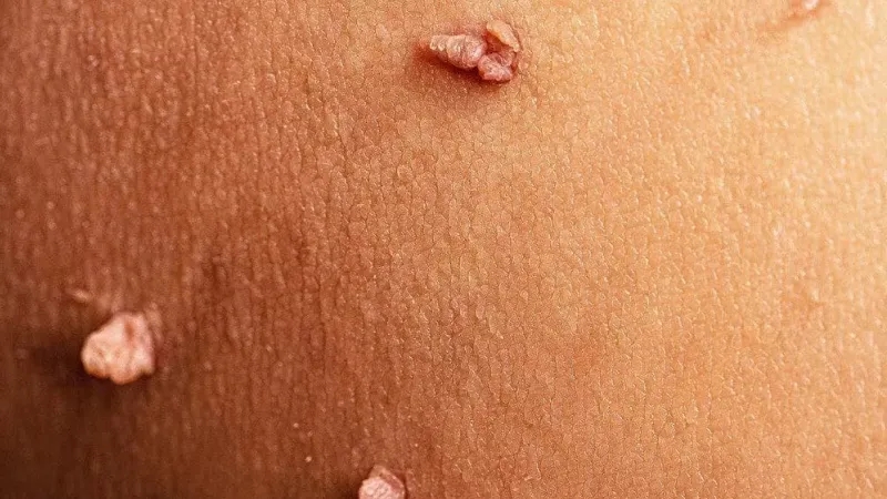 از کجا بفهمیم زگیل تناسلی داریم؟ تشخیص زگیل تناسلی در خانه