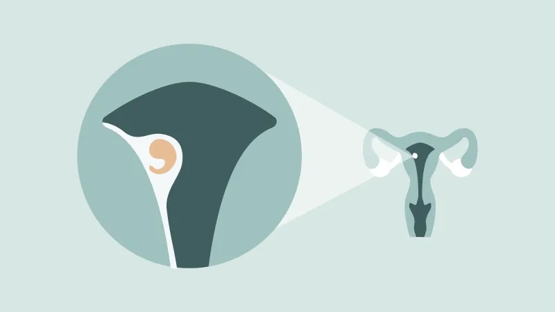 علائم لانه گزینی چیست و چه زمانی شروع می‌شود؟همراه با عکس 