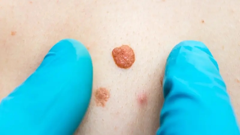 زگیل تناسلی زنان؛ علائم زگیل تناسلی در زنان، عکس و درمان