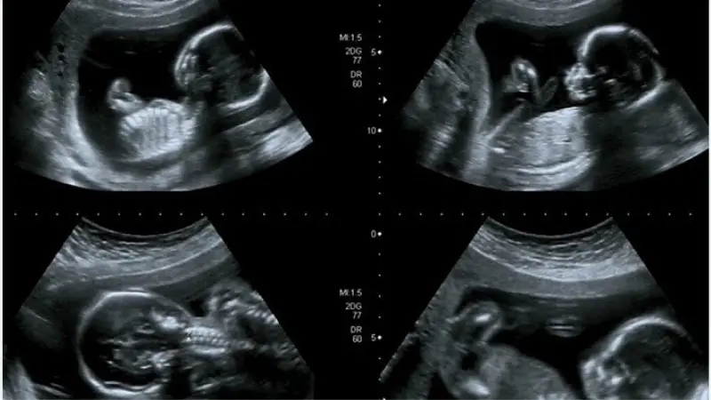 راهنما غربالگری اول به همراه اعداد نرمال آزمایش غربالگری اول