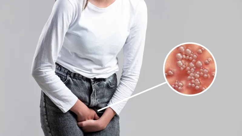 از کجا بفهمیم تبخال تناسلی داریم؟ هرپس تناسلی چیست؟