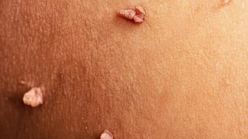 تشخیص زگیل تناسلی