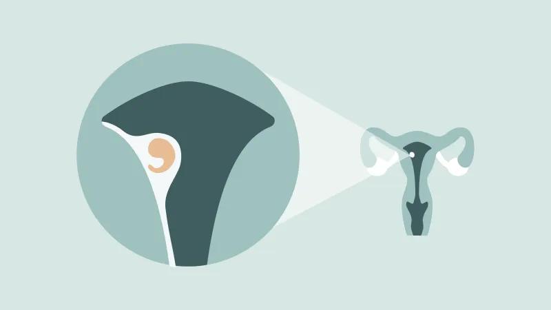 عکس واقعی خونریزی لانه گزینی