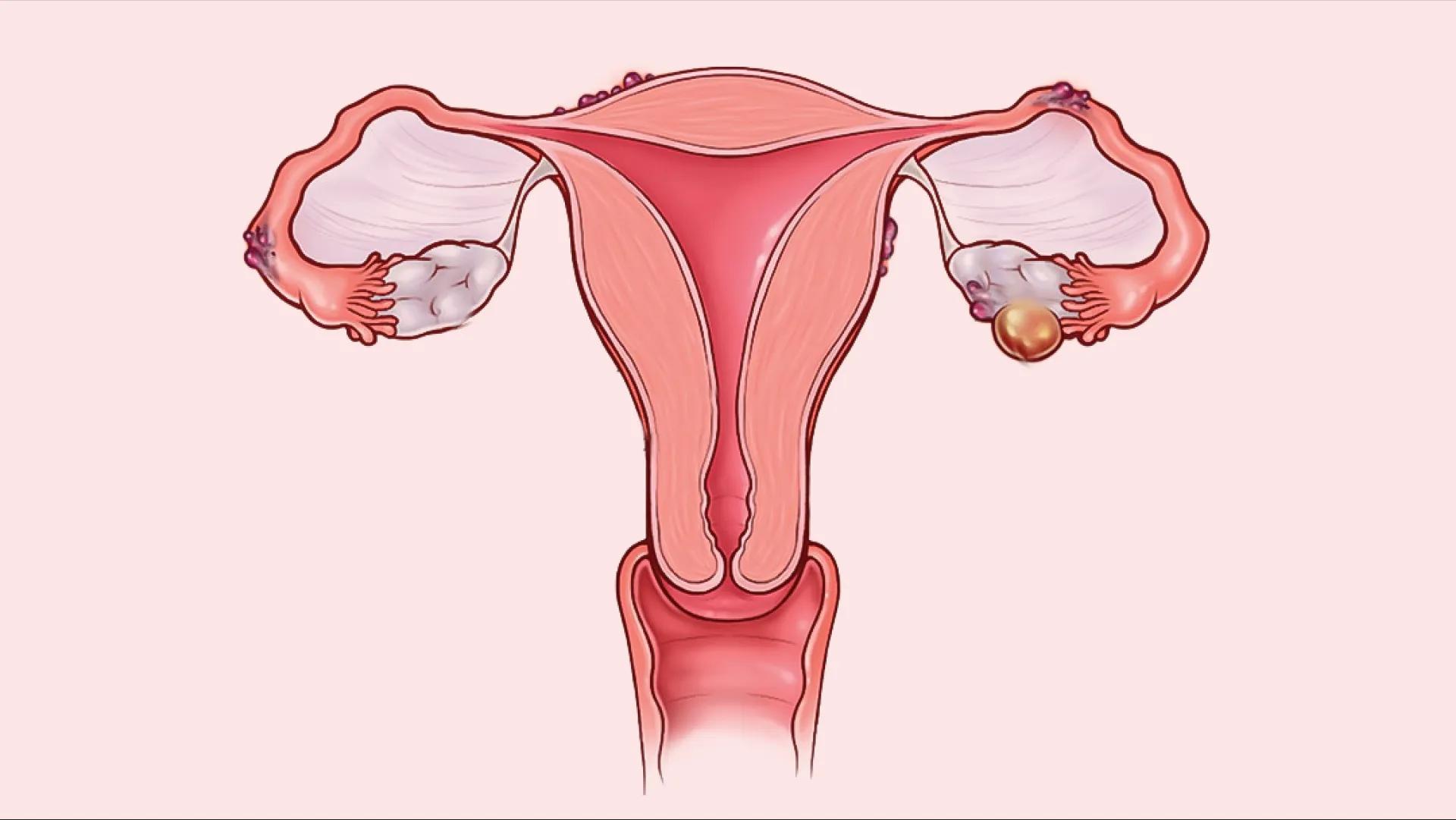  آندومتریوز