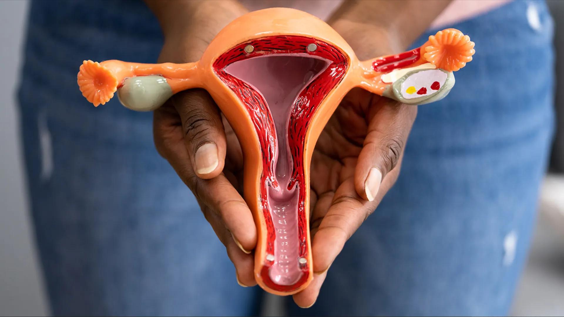 سرطان تخمدان