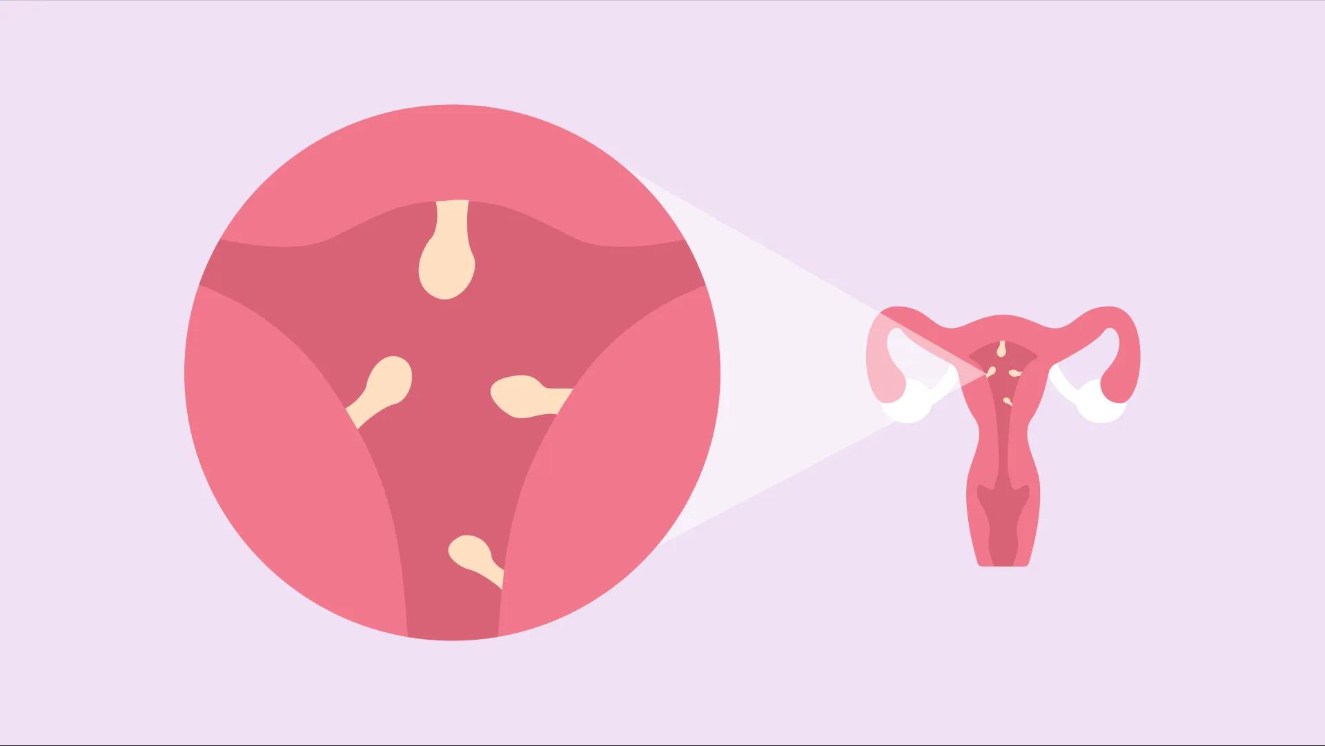 آیا فیبروم رحم خطرناک است؟