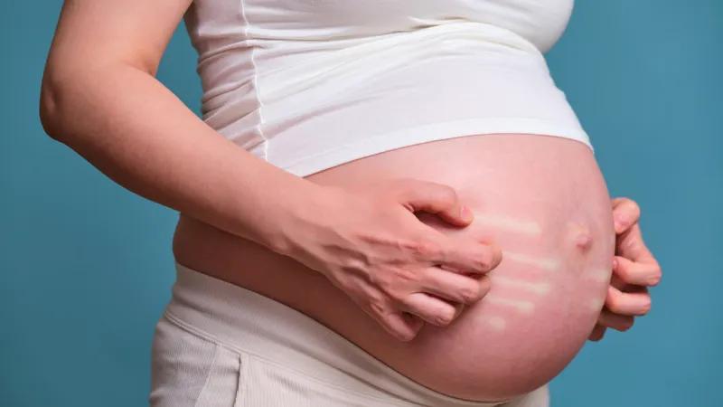 کلستاز بارداری