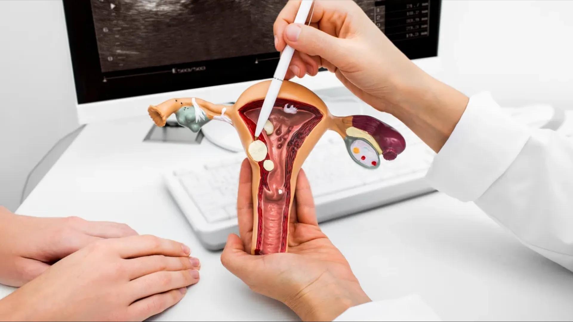 عفونت قارچی واژن