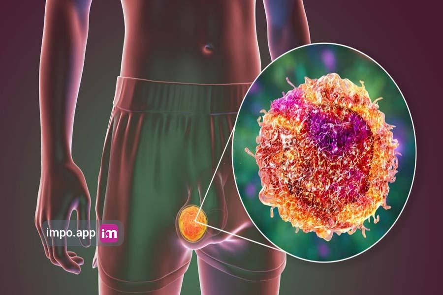 سرطان بیضه در مردان چیست؟