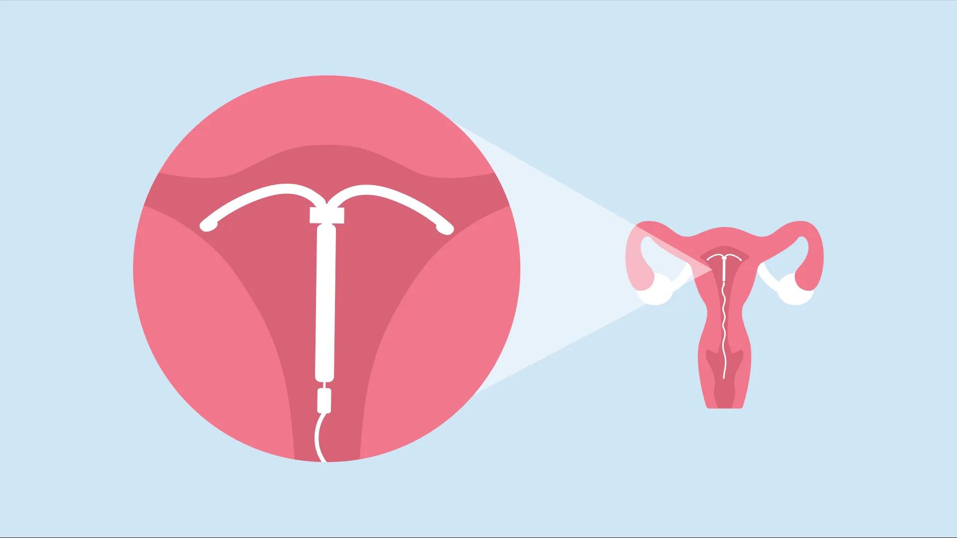 همه چیز درمورد روش پیشگیری از بارداری آی یو دی (IUD)