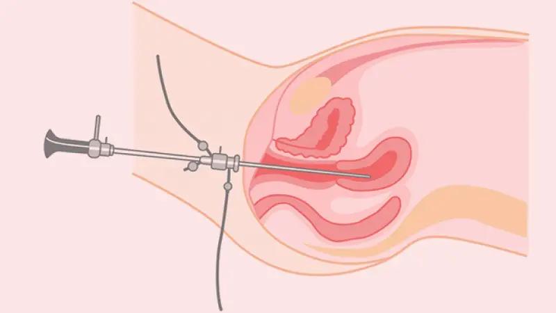 کورتاژ چیست؟