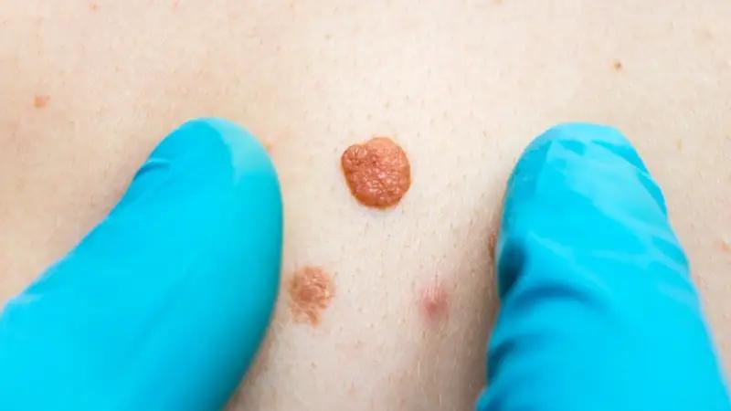 زگیل تناسلی در زنان