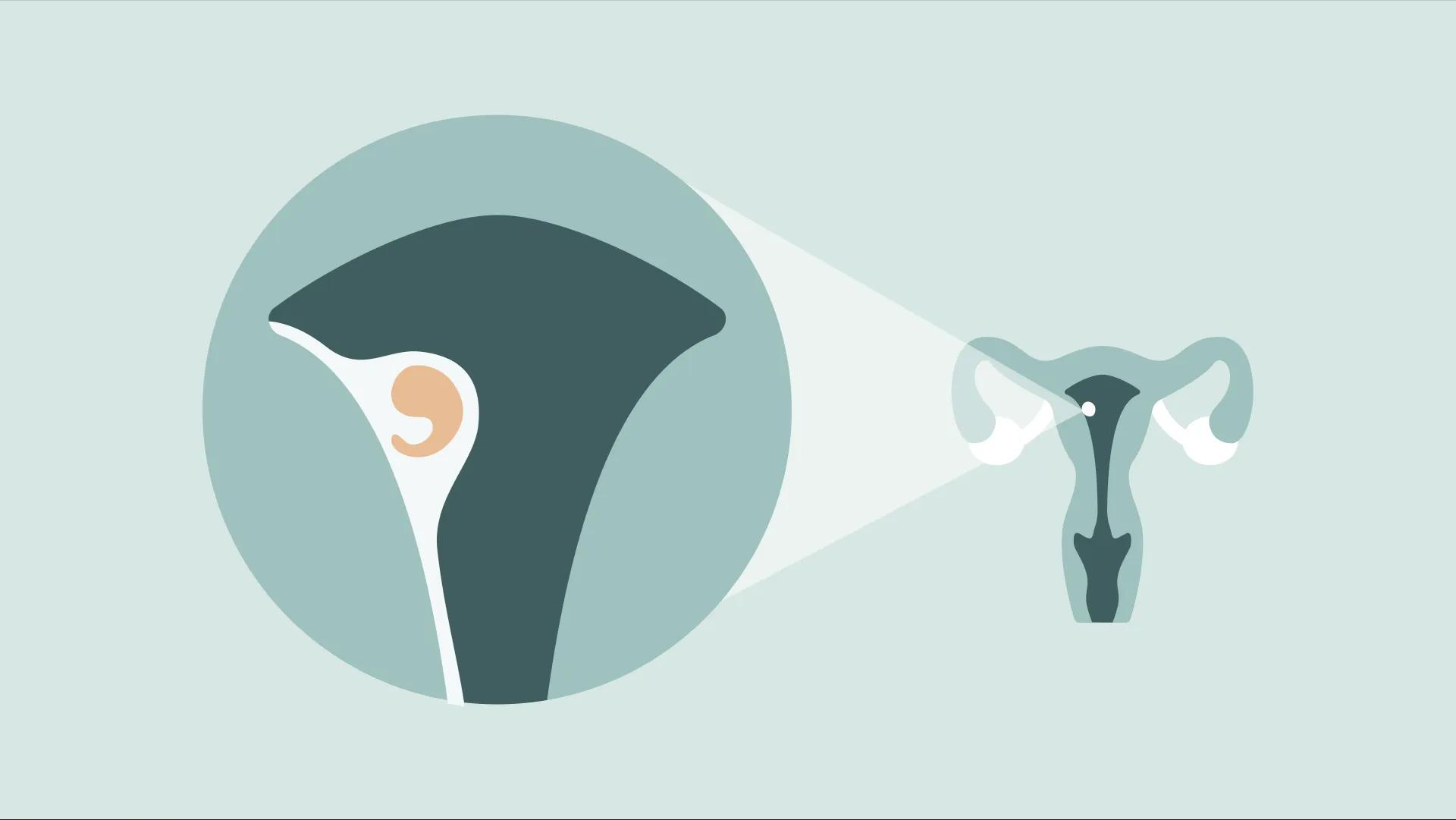 عکس واقعی خونریزی لانه گزینی