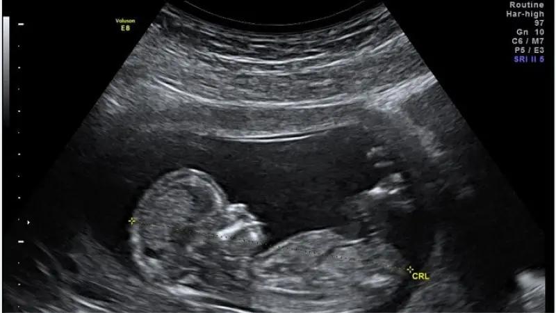 غربالگری دوم بارداری