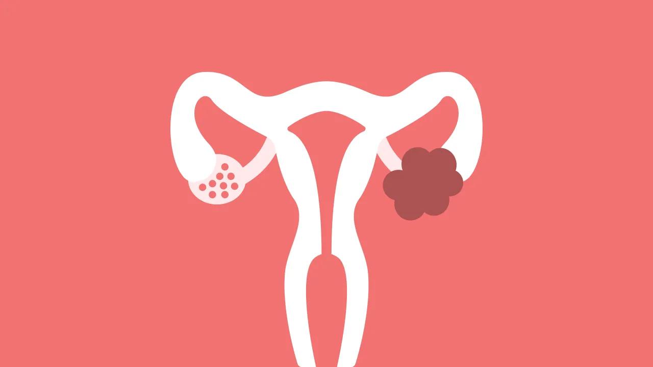 کیس تخمدان چیست