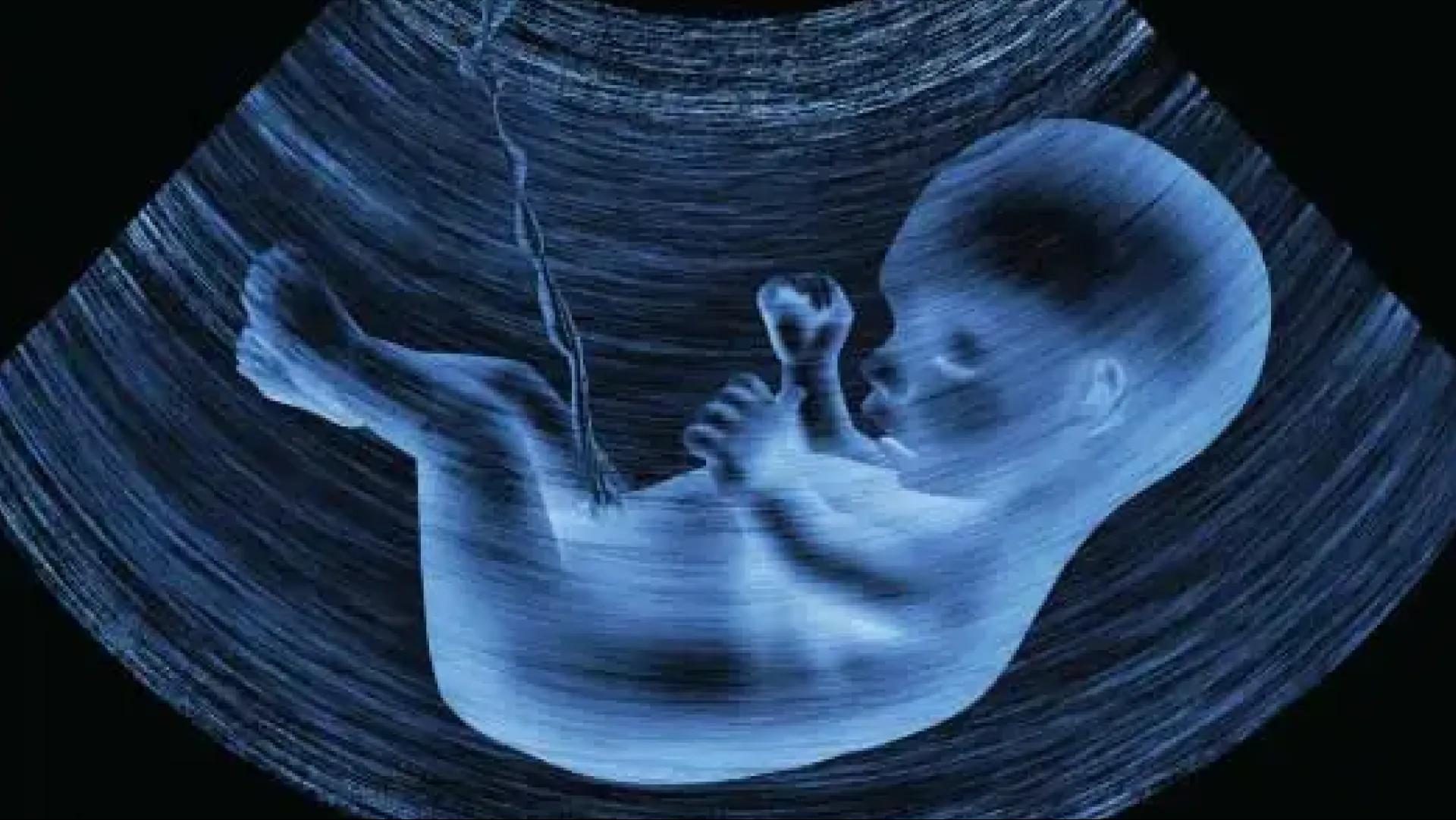 سونوگرافی NT