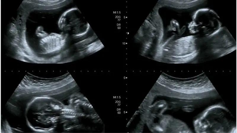 غربالگری اول